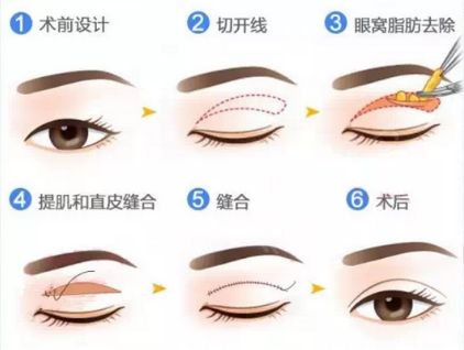 重睑成形术-客服系统|永州博美医疗美容医院|官方网站