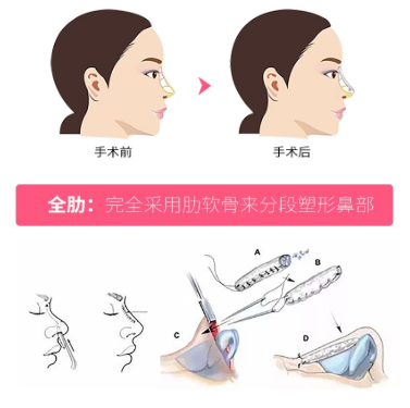 鞍鼻整形术-客服系统|永州博美医疗美容医院|官方网站