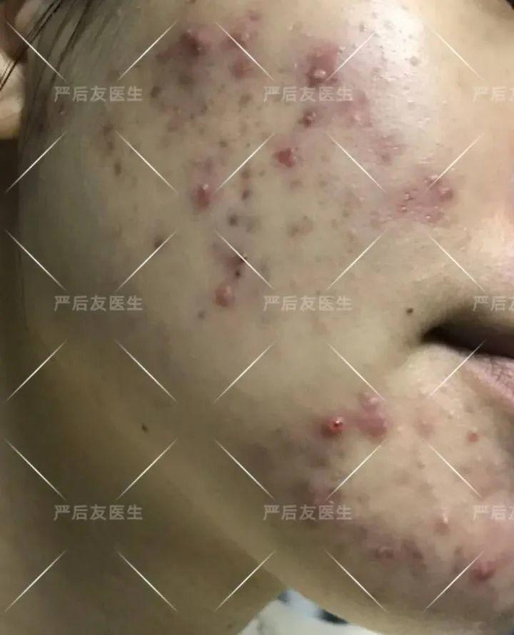 治痘痘全详细攻略,建议收藏! 治痘痘全详细攻略,建议收藏!