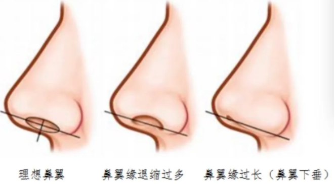 科普：鼻部整形的8大美学标准