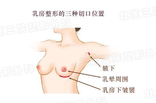 关于假体隆胸，你最关心的几个问题都有专家解答！