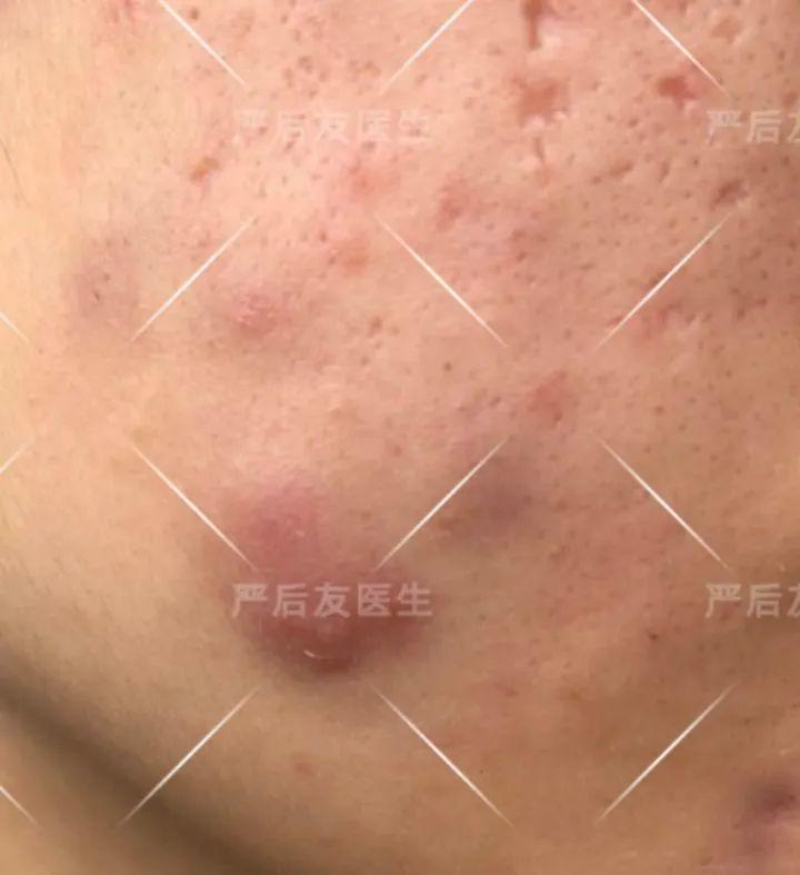 治痘痘全详细攻略,建议收藏! 治痘痘全详细攻略,建议收藏!