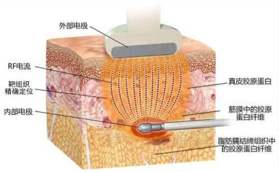 这些抗衰医美项目，让你比同龄人看起来年轻10岁！