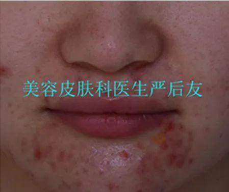 治痘痘全详细攻略，建议收藏！
