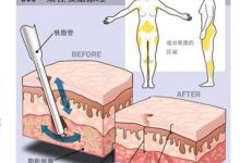 吸脂手术安全吗?-客服系统|永州博美医疗美容医院|官方网站