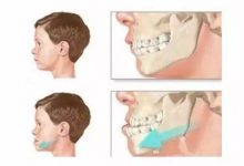 牙齿是地包天，怎么矫正？-客服系统|永州博美医疗美容医院|官方网站