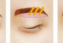 提眉术可以解决的那些问题，你必须知道……-客服系统|永州博美医疗美容医院|官方网站