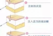打了一次玻尿酸,以后就要一直持续打吗?-客服系统|永州博美医疗美容医院|官方网站